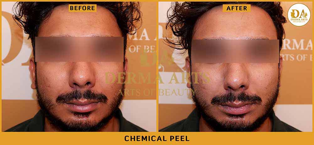 Delhi Chemical Peel before and after